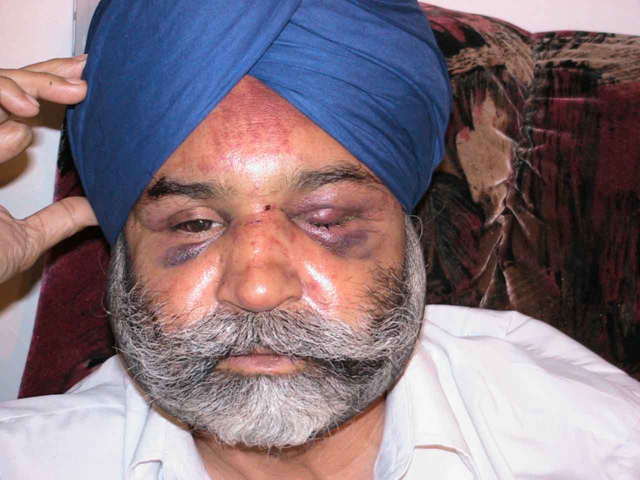 Rajinder Singh Khalsa After the Attack